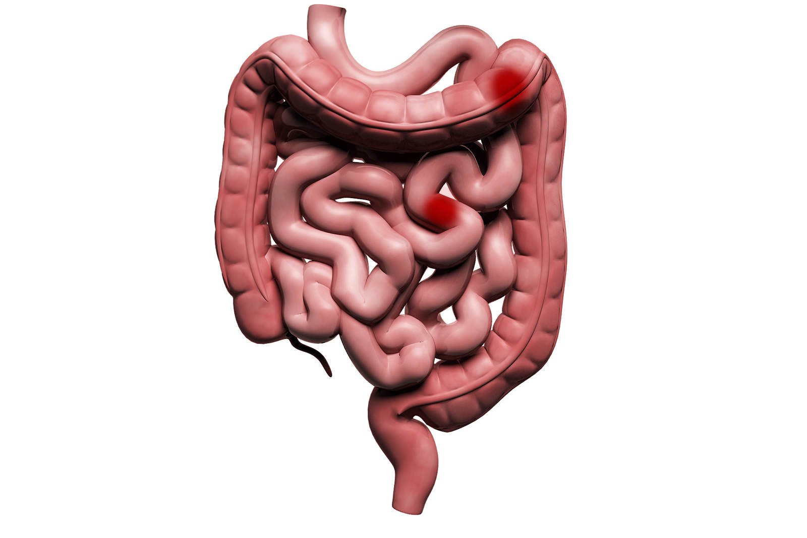 GI Bleeding Treatment